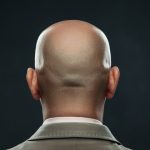 Saç Simülasyonu ile Yara Kamuflajı: Kellik ve Yara İzlerini Gizlemenin Muhteşem Yöntemi